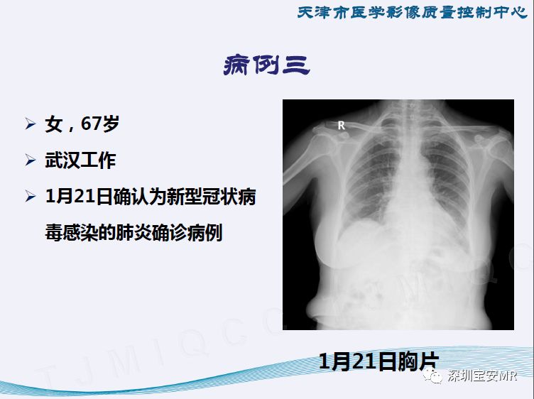 全球新型肺炎疫情進展及應對策略，最新情況與全球視野