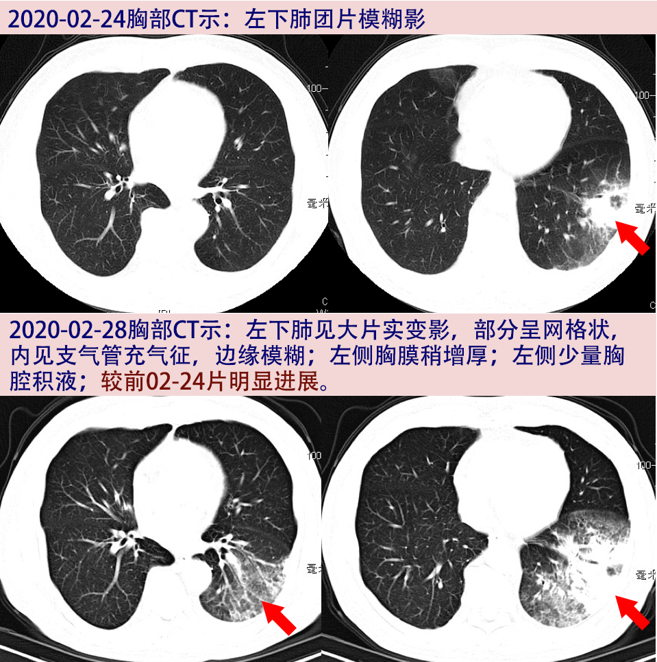 全球新冠肺炎感染挑戰(zhàn)與應(yīng)對策略最新進(jìn)展